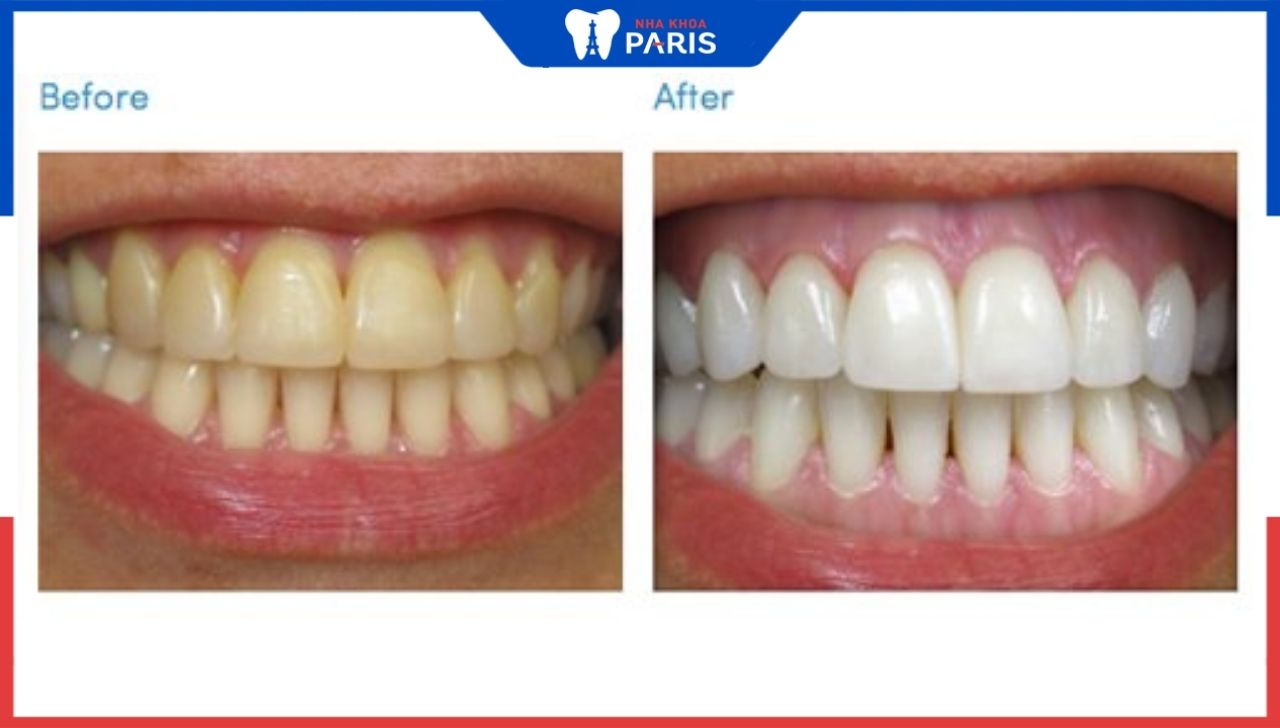 Tẩy trắng răng có hại không? Ưu nhược điểm của tẩy trắng răng